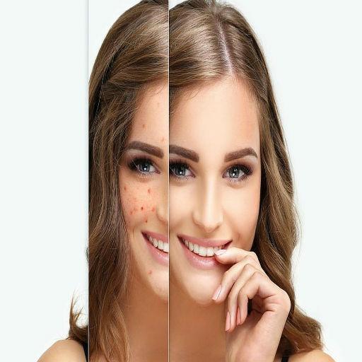 How to get ride of Freckles  (